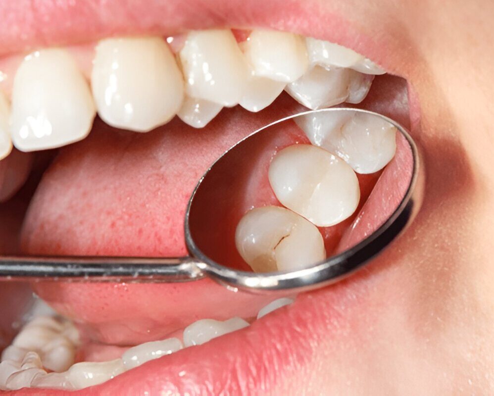 Dental Sealants Sherwood Park