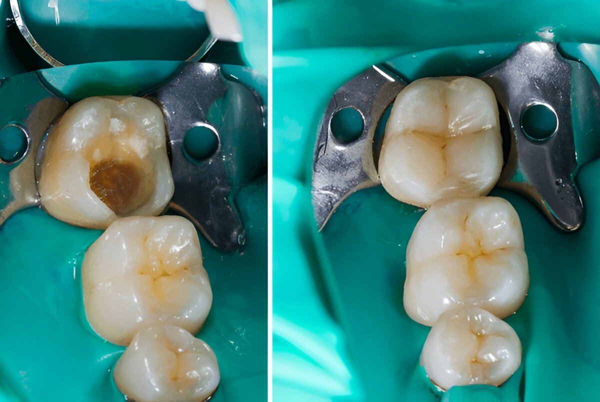 Before and after images of a tooth restored with composite filling treatment