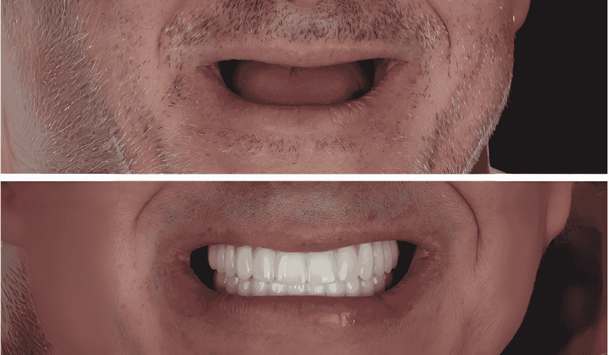 Before and after full denture treatment showing restored smile