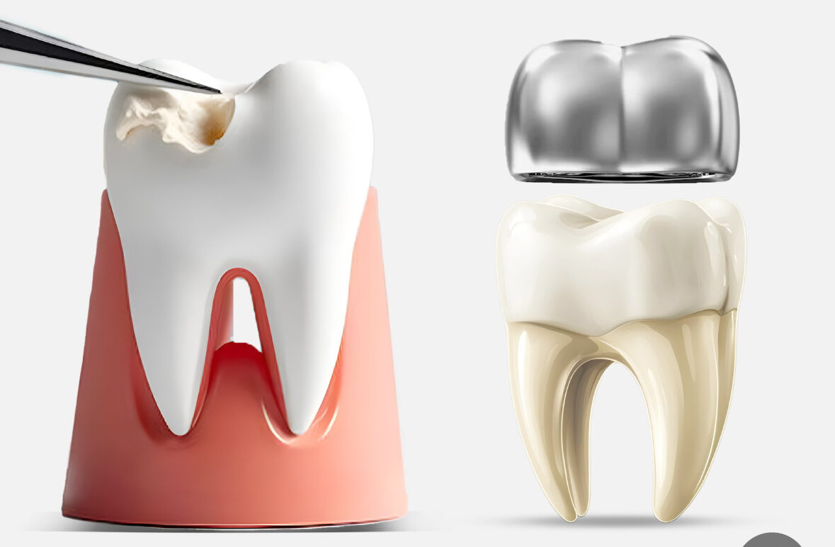 Illustration comparing composite and amalgam tooth filling options