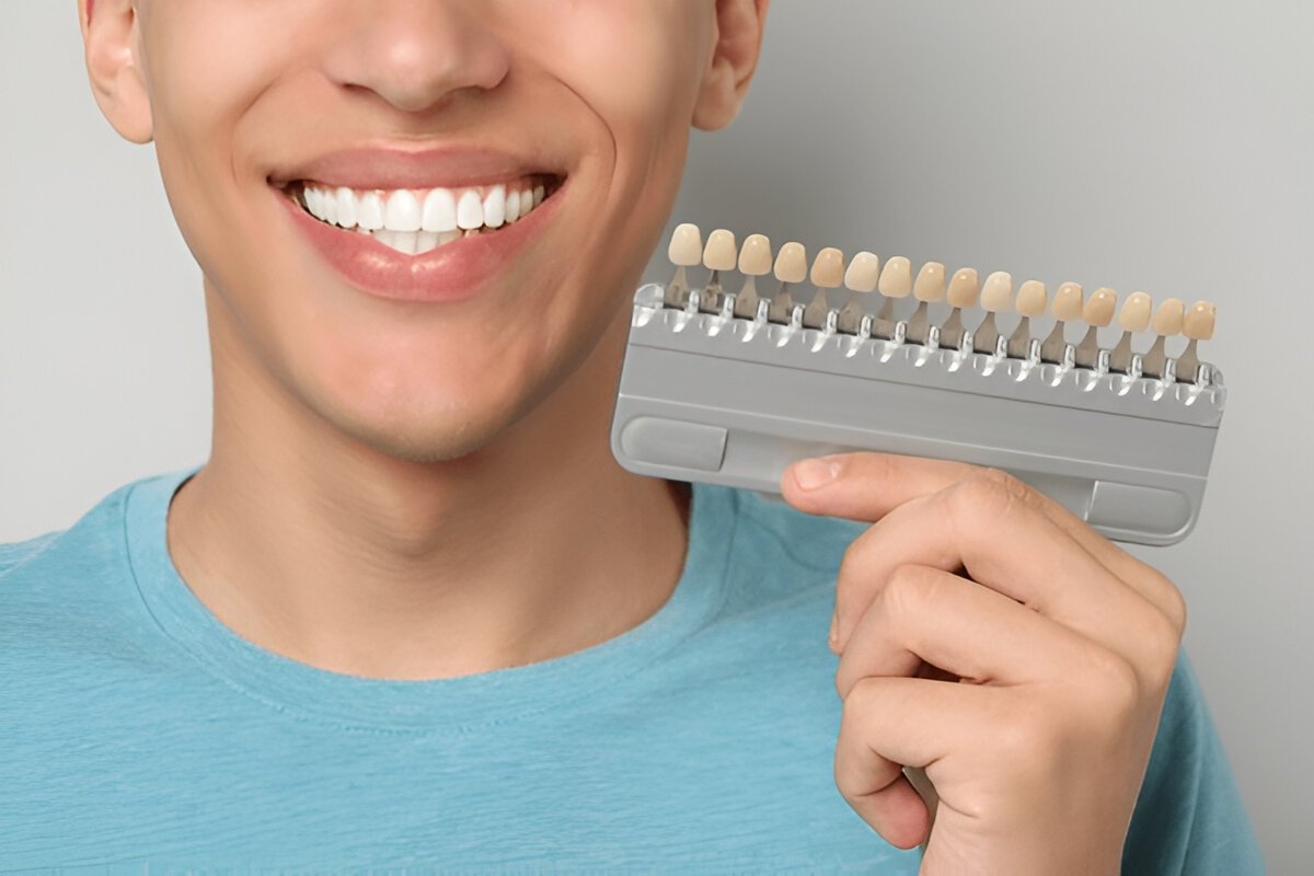 What Are Dental Veneers