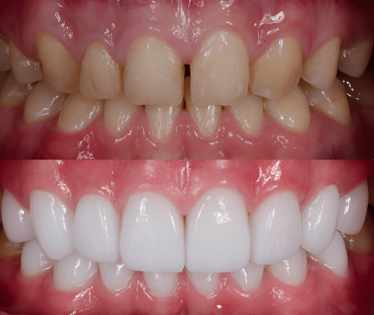 Dental Veneers Sherwood Park
