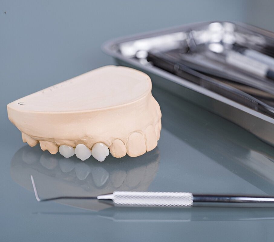 Inlays and Onlays in Sherwood Park