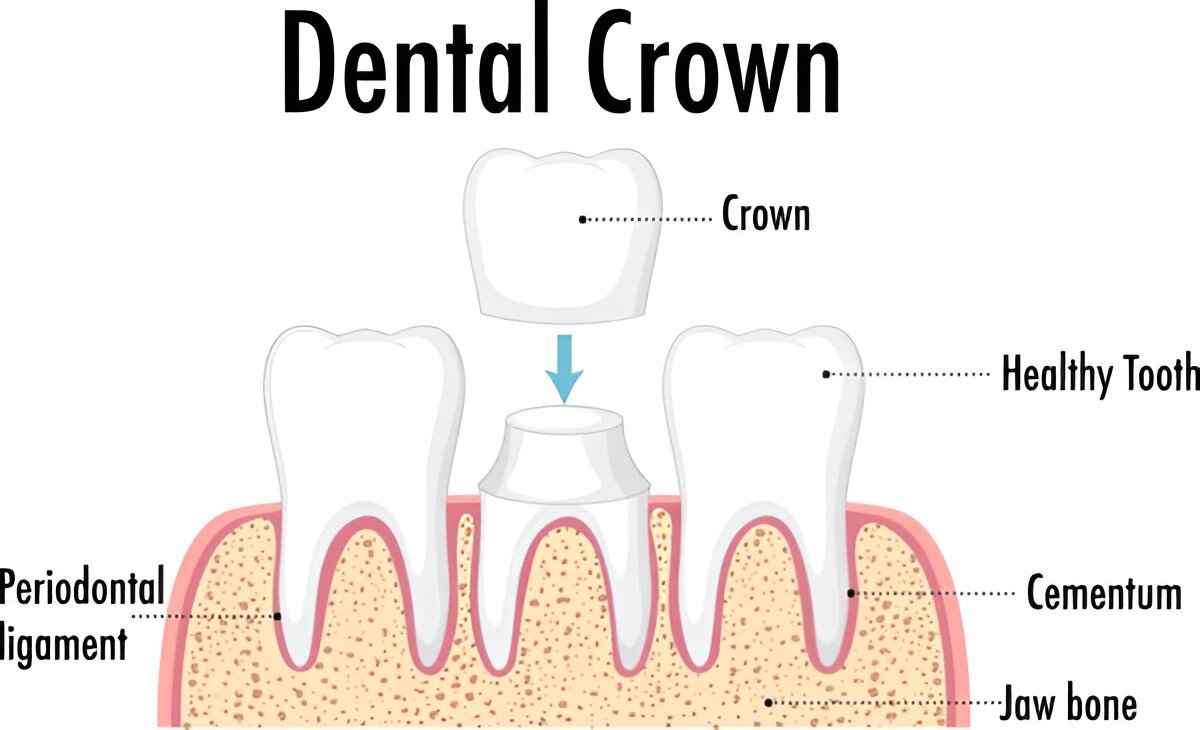 Dental Crowns Consultation