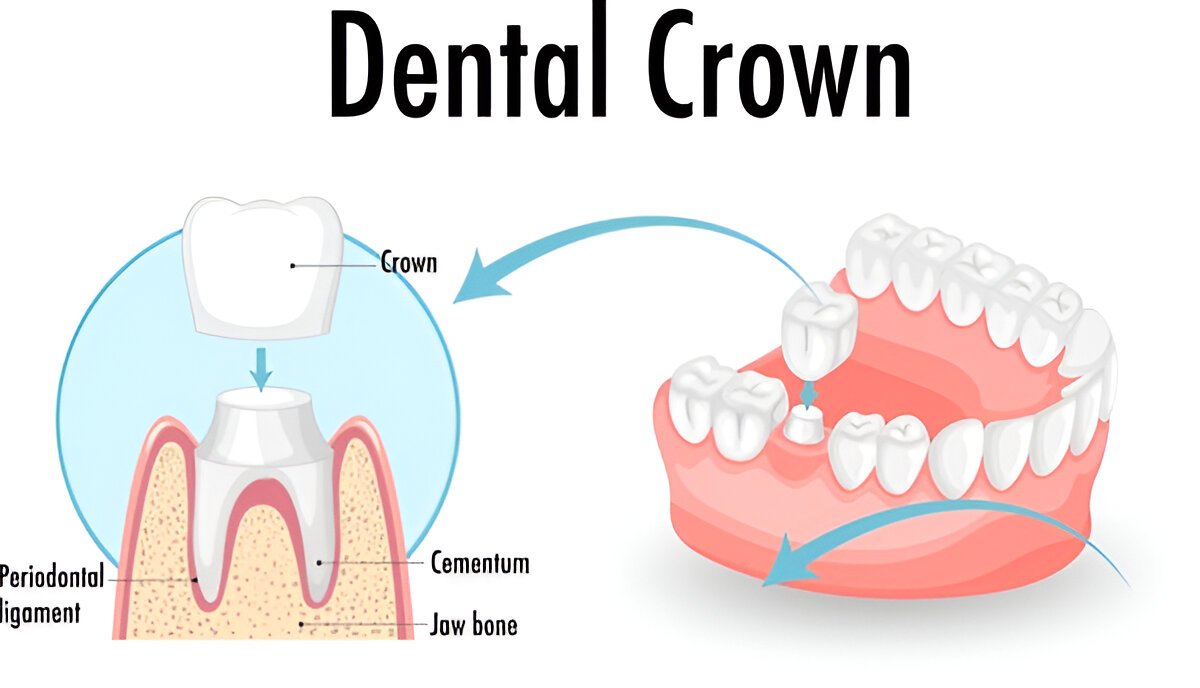 Dental Crowns Consultation